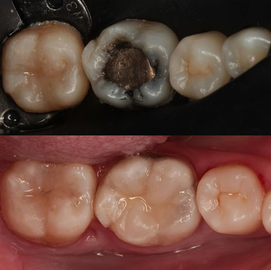 پر کردن دندان با کامپوزیت دندان