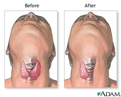 تصویر سمت چپ پیش از جراحی برداشتن بخشی از غده تیروئید و تصویر سمت راست پس از جراحی