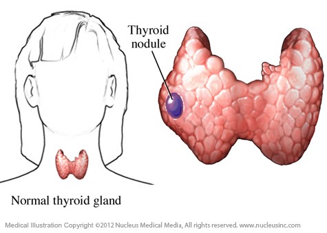 تصویر سمت چپ: غده تیروئید طبیعی، تصویر سمت راست: وجود ندول در تیروئید
