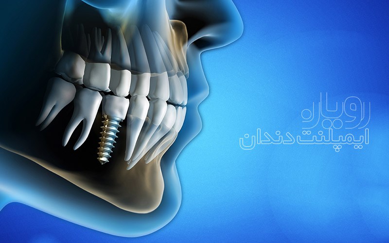 استفاده از ایمپلنت دندان در روش های درمانی