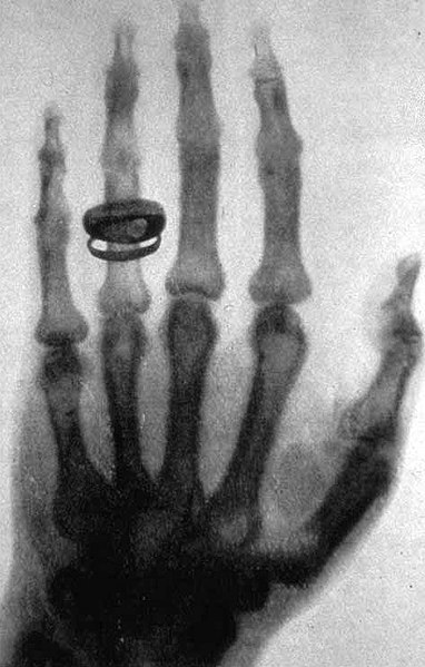 تصویر دست همسر رونتگن در سال ۱۸۹۶ یکی از اولین تصاویر عکاسی شده به وسیله اشعه ایکس